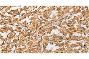 Immunohistochemistry of paraffin-embedded Human thyroid cancer tissue using ARMCX1 Polyclonal Antibody at dilution 1:40 (ARMCX1 anticorps)
