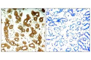 Immunohistochemical analysis of paraffin-embedded human breast carcinoma tissue using Keratin 8 (Ab-73) antibody (E021307). (Cytokeratin 18 anticorps)