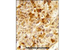 Formalin-fixed and paraffin-embedded human hepatocarcinoma reacted with PXMP3 Antibody , which was peroxidase-conjugated to the secondary antibody, followed by DAB staining.