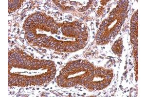 IHC-P Image Immunohistochemical analysis of paraffin-embedded human colon carcinoma, using HLA-DQB2, antibody at 1:500 dilution.