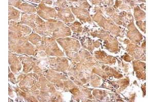 IHC-P Image GSTT1 antibody detects GSTT1 protein at cytosol on human gastric cancer by immunohistochemical analysis. (GSTT1 anticorps)