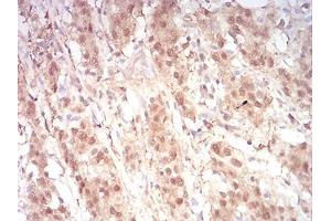 0:Immunohistochemical analysis of paraffin-embedded stomach cancer tissues using RAN mouse mAb with DAB staining.