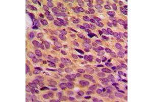 Immunohistochemical analysis of NF1 staining in human breast cancer formalin fixed paraffin embedded tissue section.