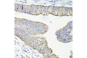 Immunohistochemistry of paraffin-embedded human colon carcinoma using ACVR2A antibody at dilution of 1:100 (x40 lens). (ACVR2A anticorps)