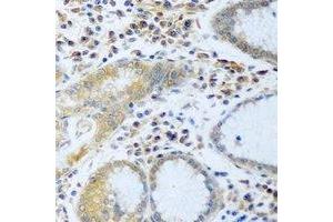 Immunohistochemical analysis of Desmoplakin staining in human stomach cancer formalin fixed paraffin embedded tissue section.