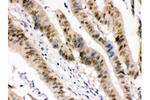 ZBTB7A was detected in paraffin-embedded sections of human intestinal cancer tissues using rabbit anti- ZBTB7A Antigen Affinity purified polyclonal antibody at 1 μg/mL.