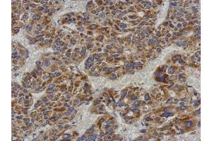 IHC-P Image Immunohistochemical analysis of paraffin-embedded human hepatoma, using ACADL, antibody at 1:500 dilution.