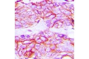 Immunohistochemical analysis of VEGFR2 (pY1214) staining in human breast cancer formalin fixed paraffin embedded tissue section. (VEGFR2/CD309 anticorps  (C-Term, pTyr1214))
