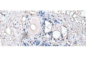 Immunohistochemistry of paraffin-embedded Human thyroid cancer tissue using PTP4A1 Polyclonal Antibody at dilution of 1:45(x200)