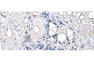 Immunohistochemistry of paraffin-embedded Human thyroid cancer tissue using PTP4A1 Polyclonal Antibody at dilution of 1:45(x200) (PTP4A1 anticorps)