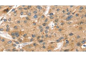 Immunohistochemistry of paraffin-embedded Human liver cancer using SORT1 Polyclonal Antibody at dilution of 1:35 (Sortilin 1 anticorps)