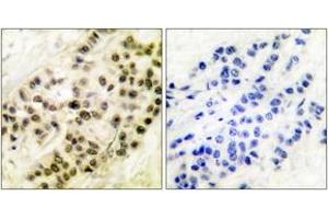 Immunohistochemistry analysis of paraffin-embedded human breast carcinoma tissue, using Cyclin B1 (Ab-126) Antibody.