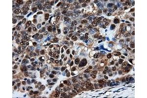 Immunohistochemical staining of paraffin-embedded Adenocarcinoma of breast tissue using anti-PSMC3 mouse monoclonal antibody. (PSMC3 anticorps)