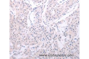 Immunohistochemistry of Human lung cancer using SPATA6 Polyclonal Antibody at dilution of 1:40 (SPATA6 anticorps)