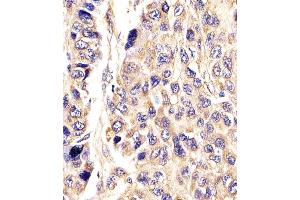 Antibody staining AGXT in Human hepatic carcinoma tissue sections by Immunohistochemistry (IHC-P - paraformaldehyde-fixed, paraffin-embedded sections). (AGXT anticorps  (AA 96-125))