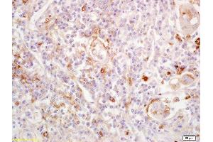 Formalin-fixed and paraffin embedded human lung carcinoma labeled with Anti-EDG1/CD363/S1P1 Polyclonal Antibody, Unconjugated  at 1:200 followed by conjugation to the secondary antibody and DAB staining. (S1PR1 anticorps  (AA 51-150))