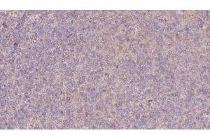 ABIN6273067 at 1/100 staining Human lymph cancer tissue by IHC-P. (PRPH2 anticorps  (Internal Region))