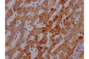IHC image of ABIN7127339 diluted at 1:100 and staining in paraffin-embedded human liver cancer performed on a Leica BondTM system. (Recombinant Angiopoietin 2 anticorps)