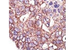 IHC analysis of FFPE human breast carcinoma tissue stained with the SYVN1 antibody (SYVN1 anticorps  (AA 586-617))