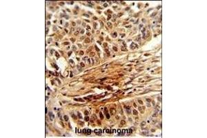 Formalin-fixed and paraffin-embedded human lung carcinoma reacted with PIN1 Antibody (Center), which was peroxidase-conjugated to the secondary antibody, followed by DAB staining.