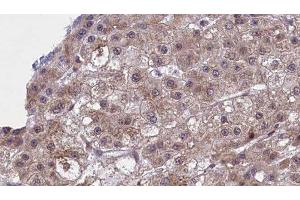 ABIN6277451 at 1/100 staining Human liver cancer tissue by IHC-P. (SLC22A8 anticorps  (N-Term))