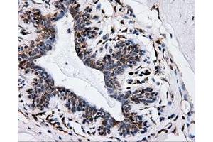 Immunohistochemical staining of paraffin-embedded breast tissue using anti-IFT57 mouse monoclonal antibody. (IFT57 anticorps)