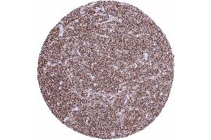 Lymph node Diffuse large B cell lymphoma showing strong CD45 staining of tumor cells