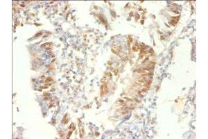 Immunohistochemistry of paraffin-embedded human colon cancer using ABIN7164919 at dilution of 1:100 (PSME3 anticorps  (AA 2-252))