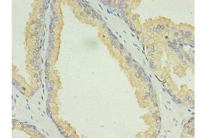 Immunohistochemistry of paraffin-embedded human prostate cancer using ABIN7158804 at dilution of 1:100 (LAMP2 anticorps  (AA 54-268))