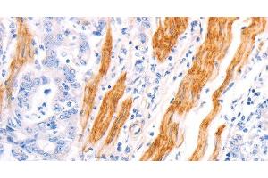 Immunohistochemistry of paraffin-embedded Human gastric cancer using TPM1 Polyclonal Antibody at dilution of 1:40 (Tropomyosin anticorps)
