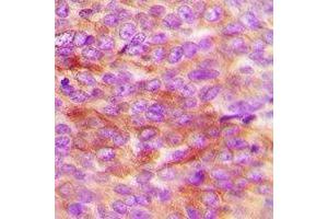 Immunohistochemical analysis of HSP20 (pS16) staining in human breast cancer formalin fixed paraffin embedded tissue section.