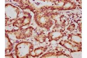 IHC image of ABIN7142087 diluted at 1:1000 and staining in paraffin-embedded human colon cancer performed on a Leica BondTM system.