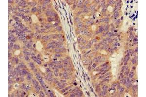 Immunohistochemistry of paraffin-embedded human colon cancer using ABIN7160758 at dilution of 1:100