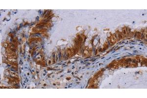 Immunohistochemistry of paraffin-embedded Human esophagus cancer using MECP2 Polyclonal Antibody at dilution of 1:60 (MECP2 anticorps)