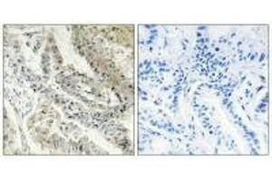 Immunohistochemistry analysis of paraffin-embedded human lung carcinoma tissue, using CRBP III antibody. (Retinol Binding Protein 5 anticorps)