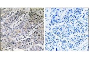 Immunohistochemistry analysis of paraffin-embedded human lung carcinoma tissue, using BRP44 Antibody. (BRP44 anticorps  (AA 31-80))