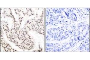 Immunohistochemistry analysis of paraffin-embedded human breast carcinoma, using Elk1 (Phospho-Thr417) Antibody. (ELK1 anticorps  (pThr417))