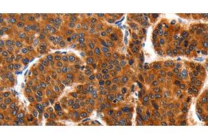 Immunohistochemistry of paraffin-embedded Human liver cancer using HSP75 Polyclonal Antibody at dilution of 1:100 (TRAP1 anticorps)