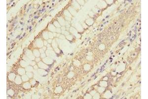 Immunohistochemistry of paraffin-embedded human colon cancer using ABIN7160191 at dilution of 1:100 (MTHFD1L anticorps  (AA 759-978))