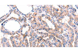 Immunohistochemistry of paraffin-embedded Human thyroid cancer tissue using GRK2 Polyclonal Antibody at dilution 1:87 (GRK2 anticorps)