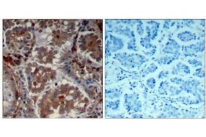 Immunohistochemical analysis of paraffin-embedded human Lung carcinoma tissue using mTOR (Ab-2448) Antibody (E021214). (MTOR anticorps)