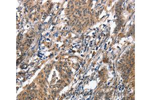 Immunohistochemistry of Human liver cancer using ALOX15 Polyclonal Antibody at dilution of 1:50 (ALOX15 anticorps)