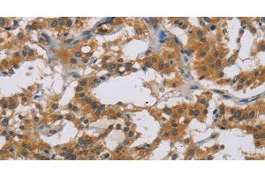 Immunohistochemistry of paraffin-embedded Human thyroid cancer tissue using IL18R1 Polyclonal Antibody at dilution 1:40 (IL18R1 anticorps)
