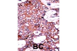 Formalin-fixed and paraffin-embedded human cancer tissue reacted with CDC25A (phospho S75) polyclonal antibody  which was peroxidase-conjugated to the secondary antibody followed by AEC staining. (CDC25A anticorps  (pSer76))