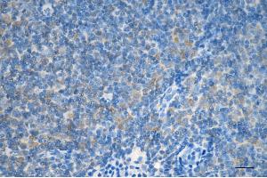 Immunohistochemistry was performed on paraffin-embedded human lymphoma using LC3B antibody (ABIN7799410), 1:200).