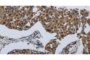 Immunohistochemistry of paraffin-embedded Human breast cancer using PRKAR1B Polyclonal Antibody at dilution of 1:70 (PRKAR1B anticorps)