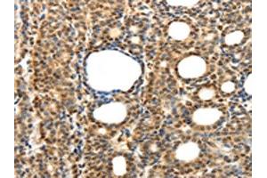 The image on the left is immunohistochemistry of paraffin-embedded Human thyroid cancer tissue using ABIN7131276(SYT7 Antibody) at dilution 1/15, on the right is treated with fusion protein. (SYT7 anticorps)