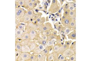 Immunohistochemistry of paraffin-embedded human liver cancer using KLKB1 antibody at dilution of 1:200 (400x lens). (KLKB1 anticorps)