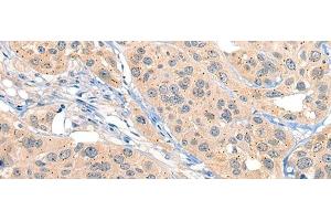 Immunohistochemistry of paraffin-embedded Human esophagus cancer tissue using MIIP Polyclonal Antibody at dilution of 1:45(x200) (MIIP anticorps)