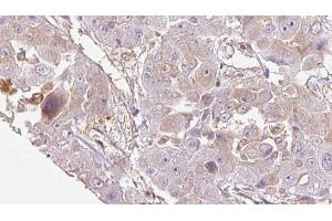 ABIN6272714 at 1/100 staining Human liver cancer tissue by IHC-P. (OR1E1 anticorps  (C-Term))